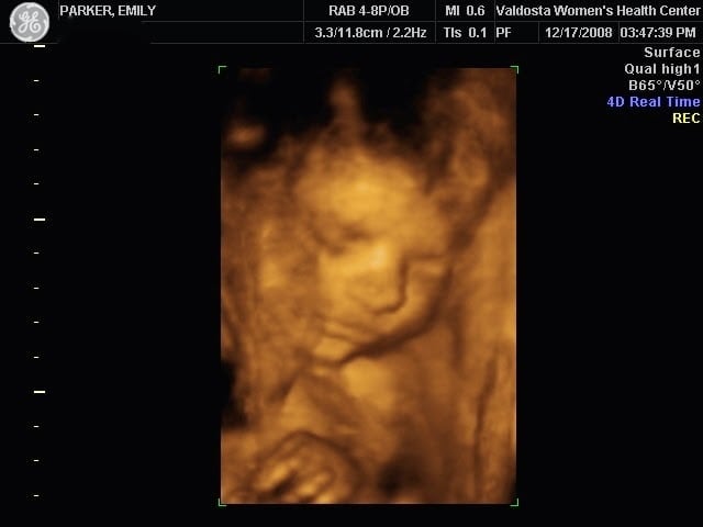 4d Ultrasound