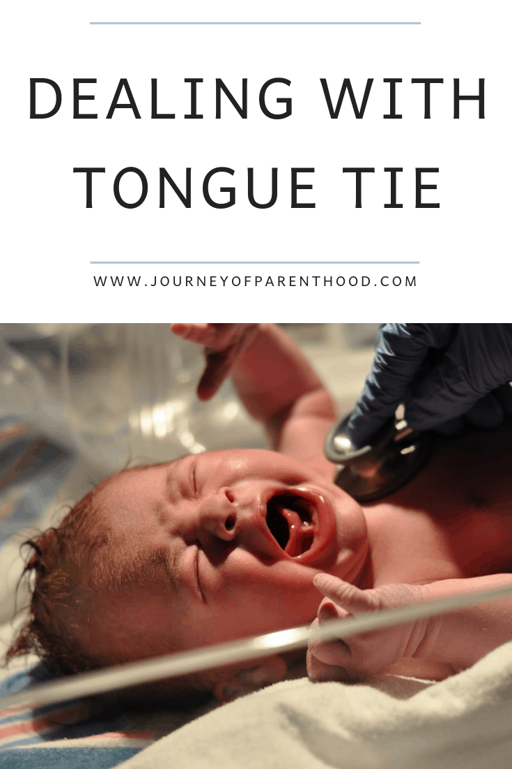 what to expect with tongue tie