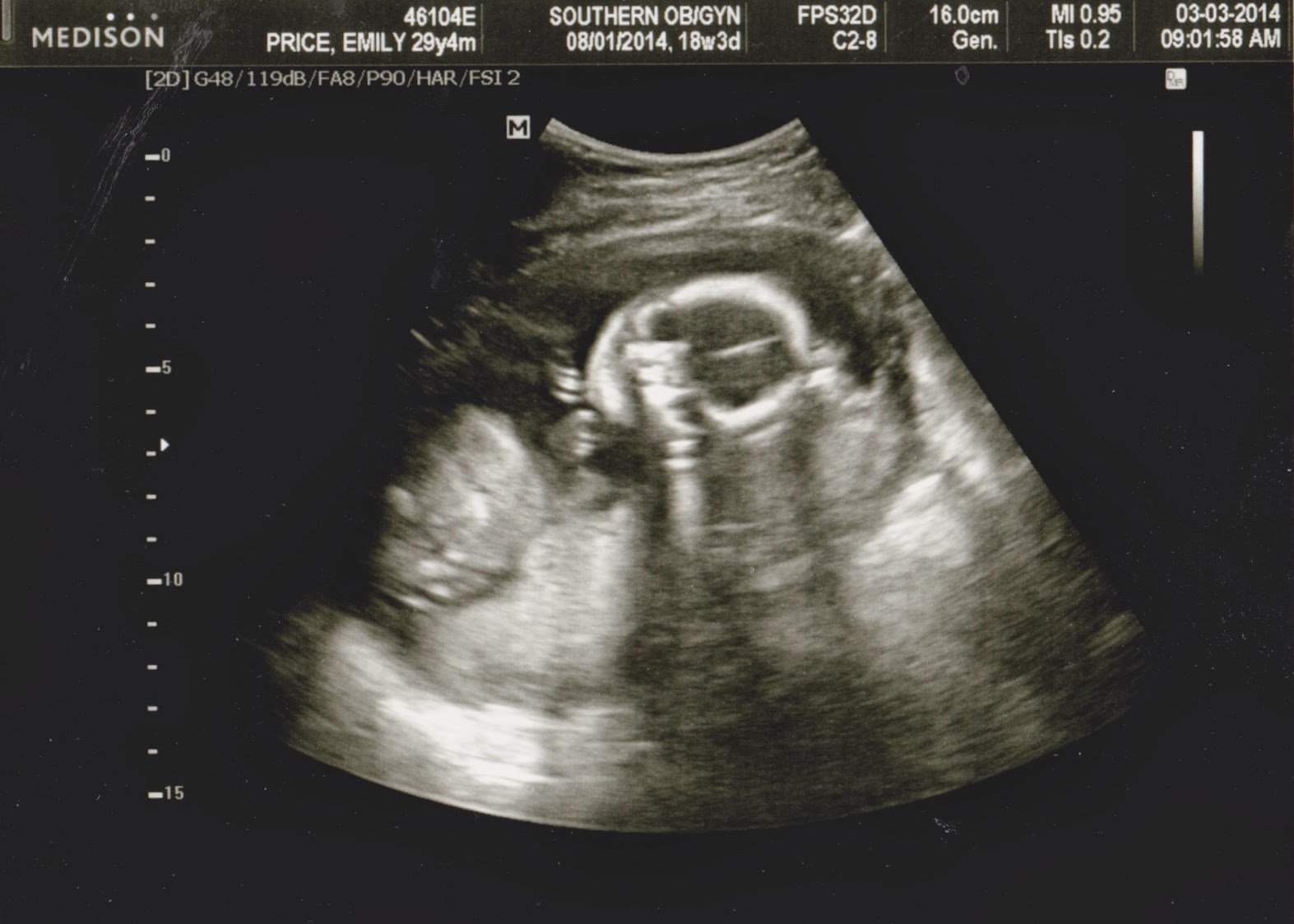 18 Week OBGYN Visit and Ultrasound!