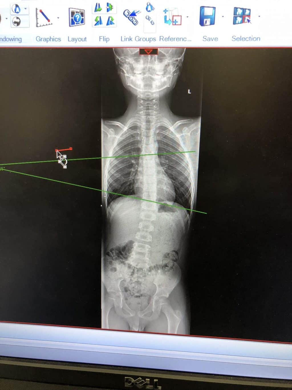 Functional Scoliosis – Leg Length Discrepancy