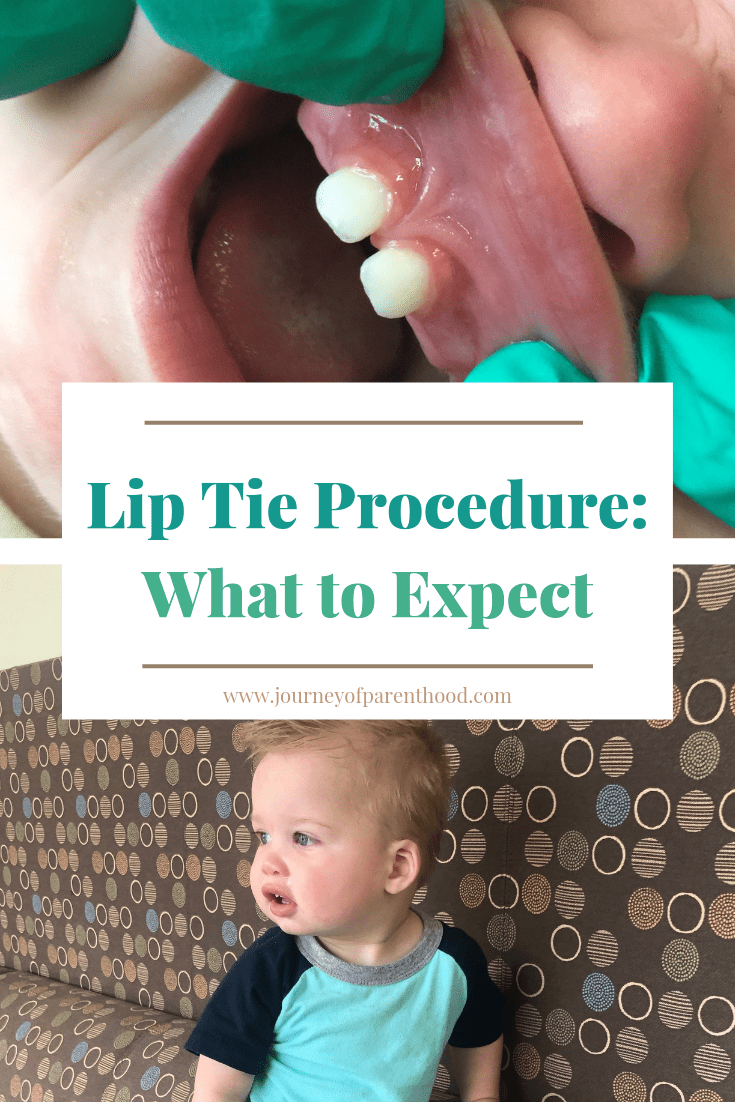 lip tie procedure
