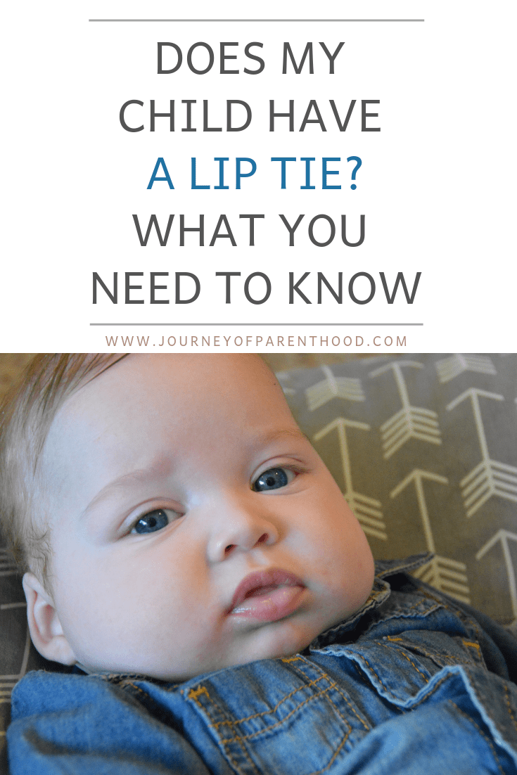 lip tie procedure