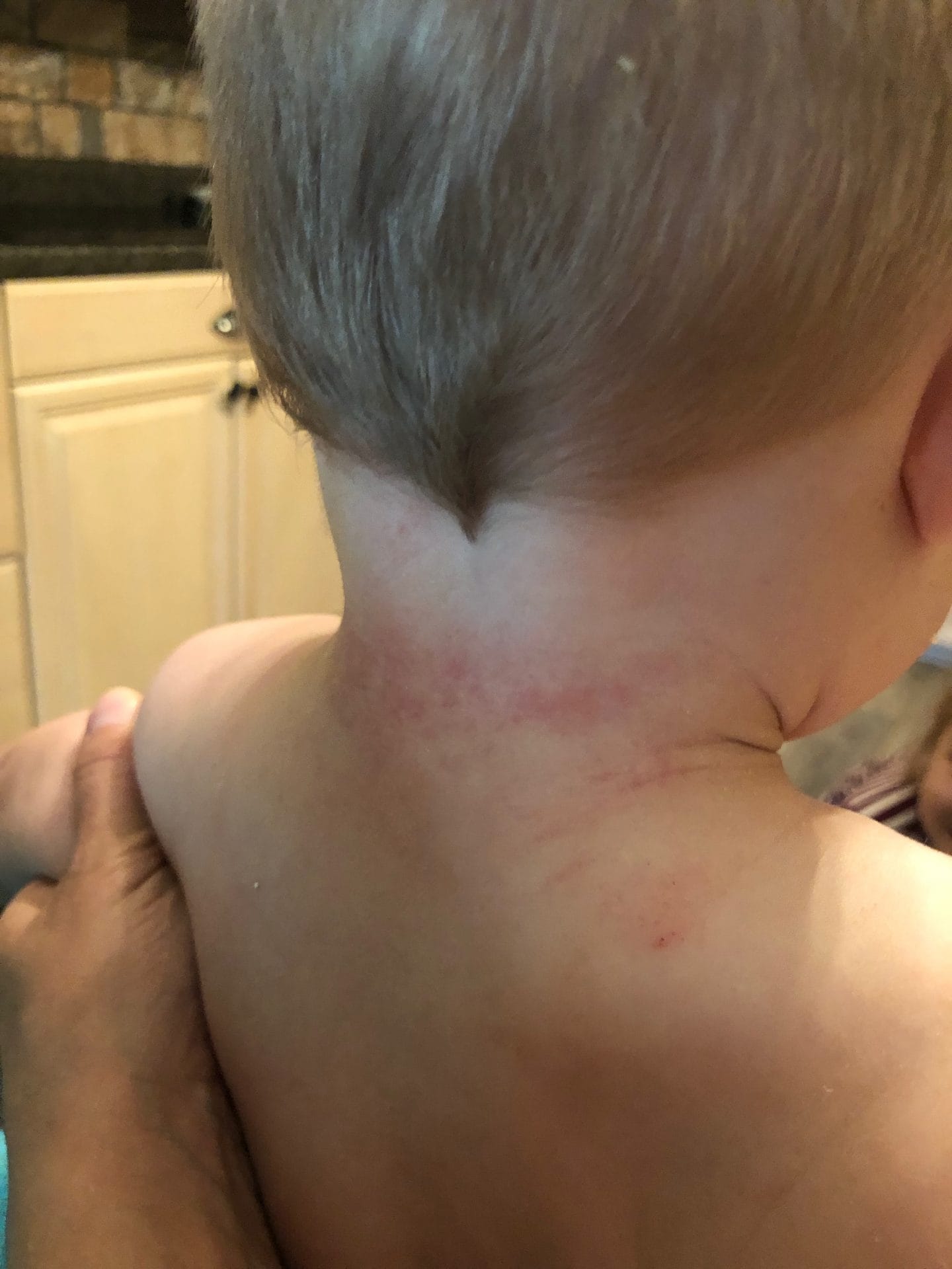 eczema rash in toddler