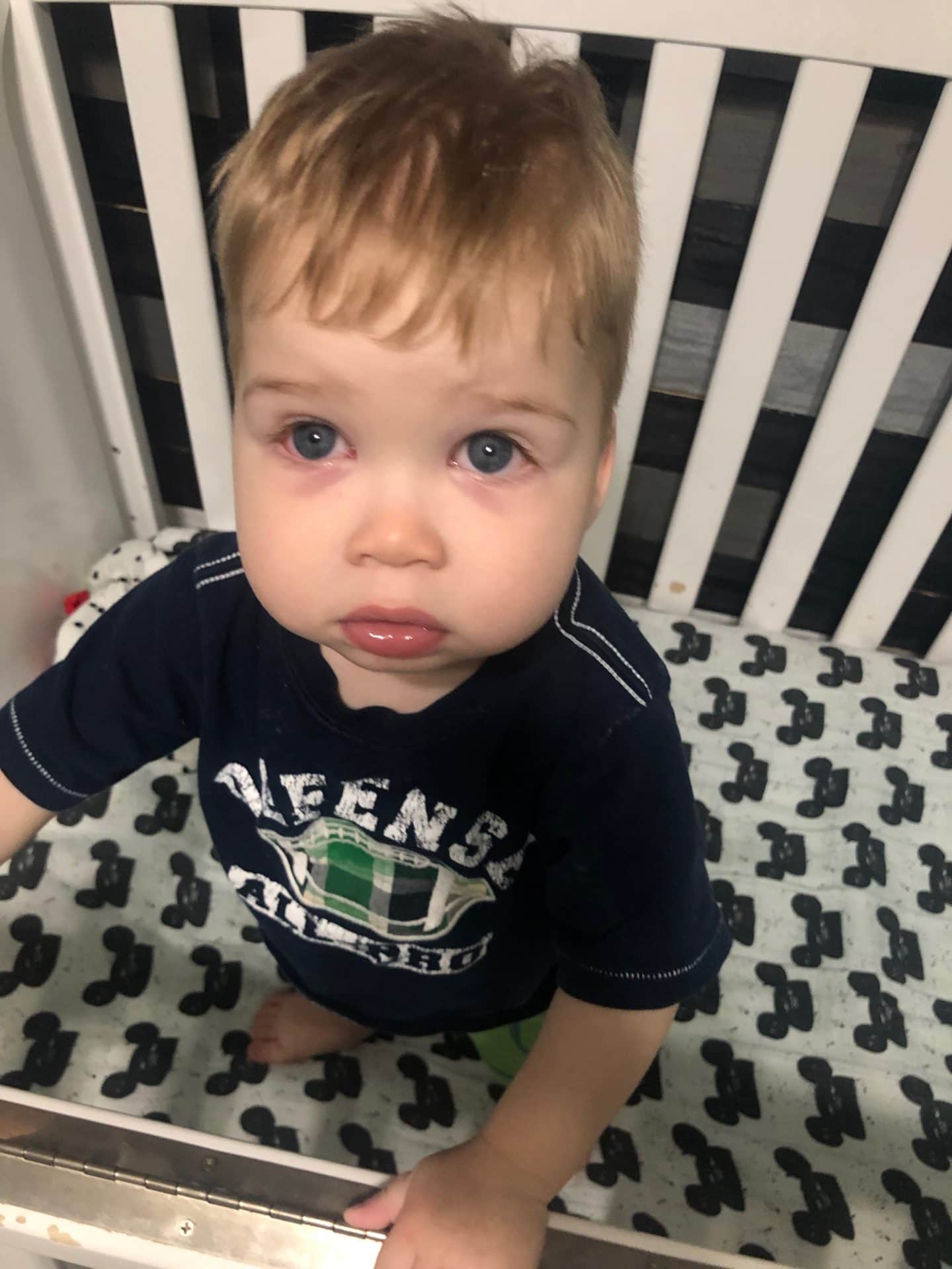 pink eye in toddler