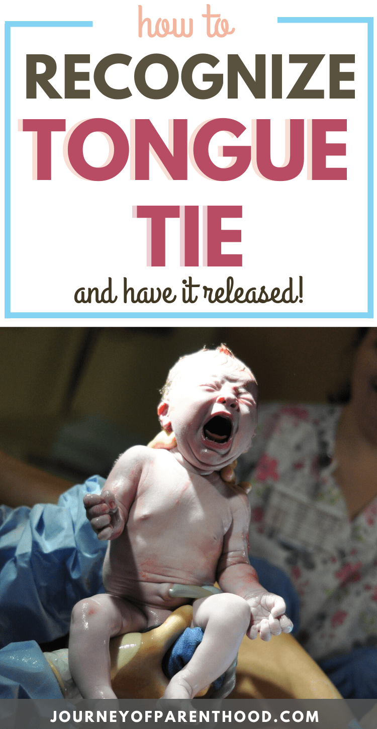 how to recognize tongue tie and have it released