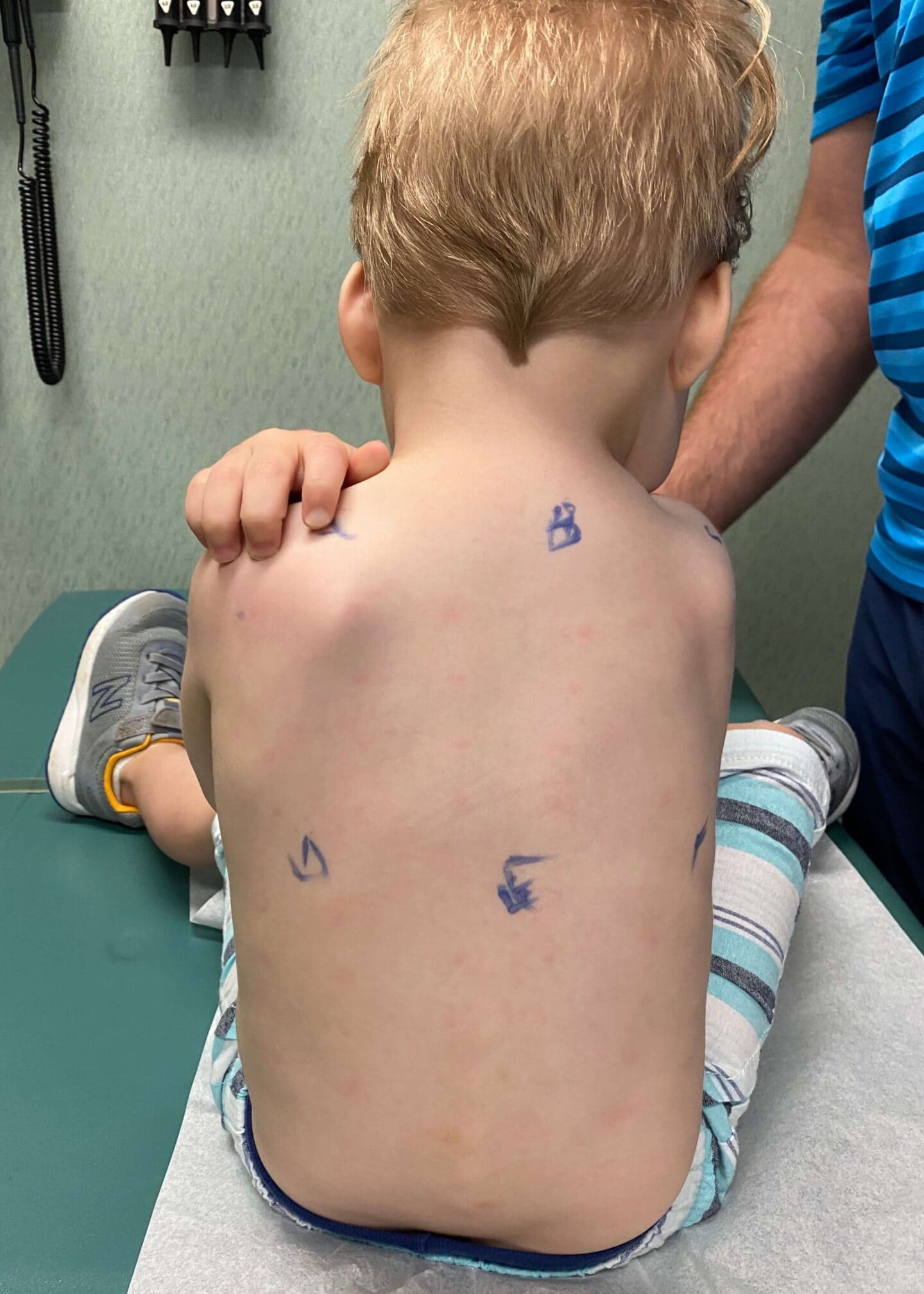 allergy testing for toddler