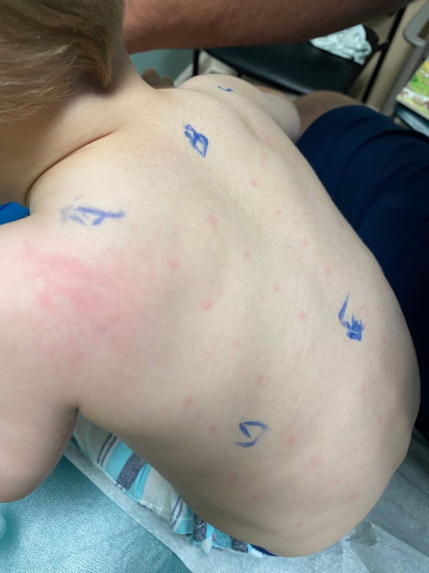 allergy testing for toddler