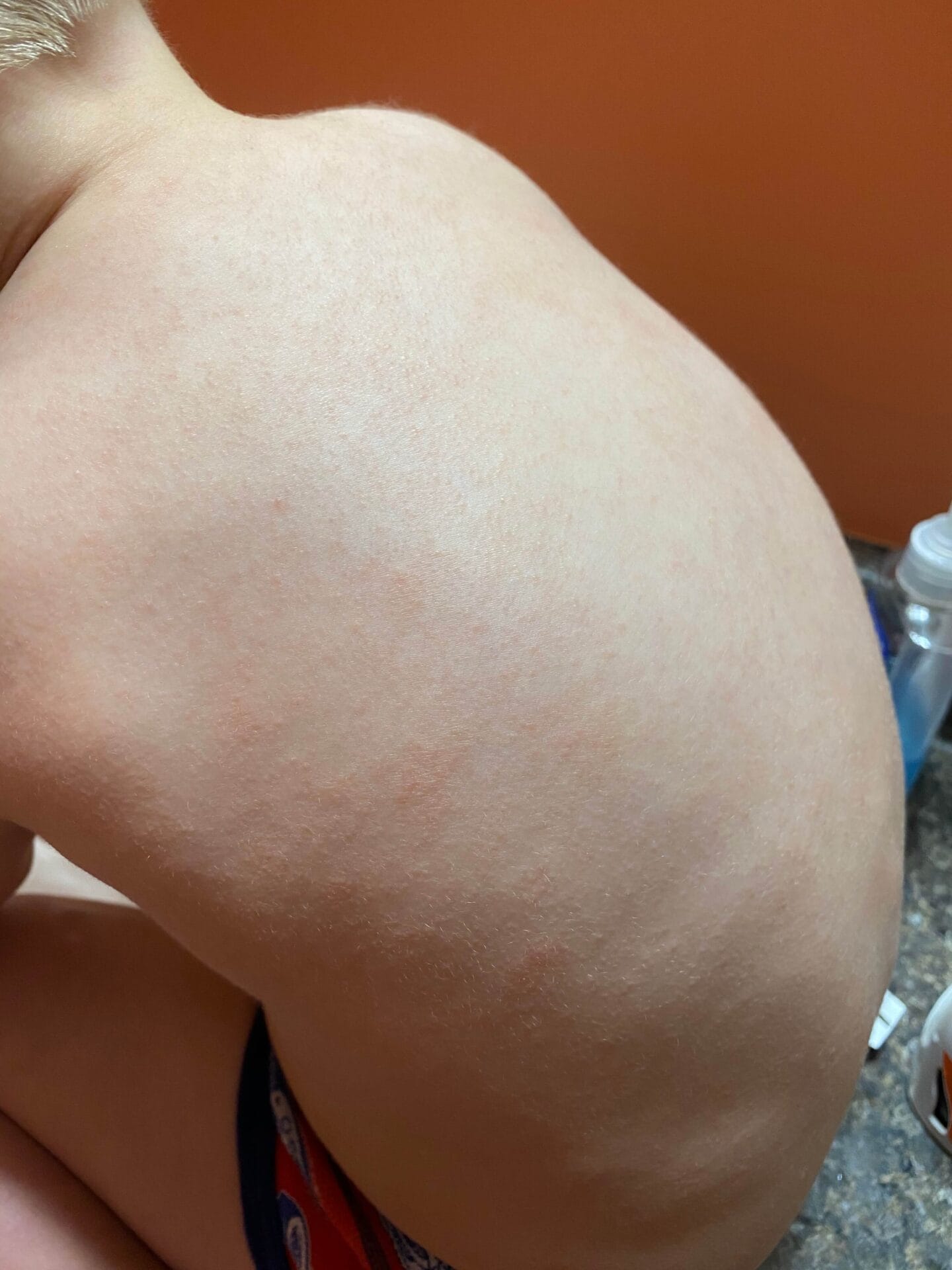 toddler skin rash - eczema