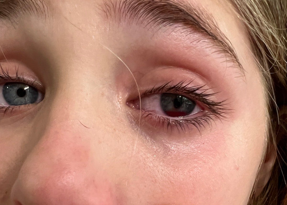 Nerf Guns and Eye Injuries