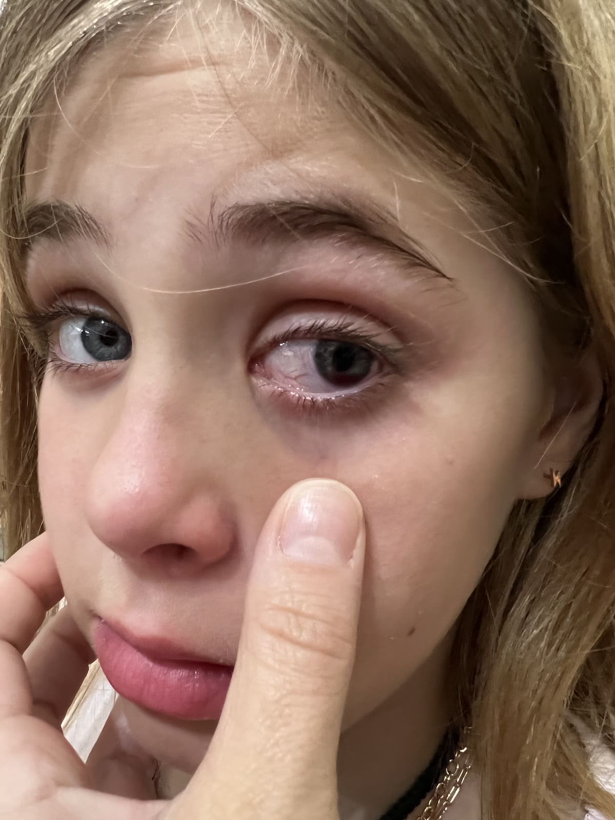 Nerf Gun Eye Injury: What To Do When Your Child Has Been Hit in the Eye with Nerf Dart Bullet