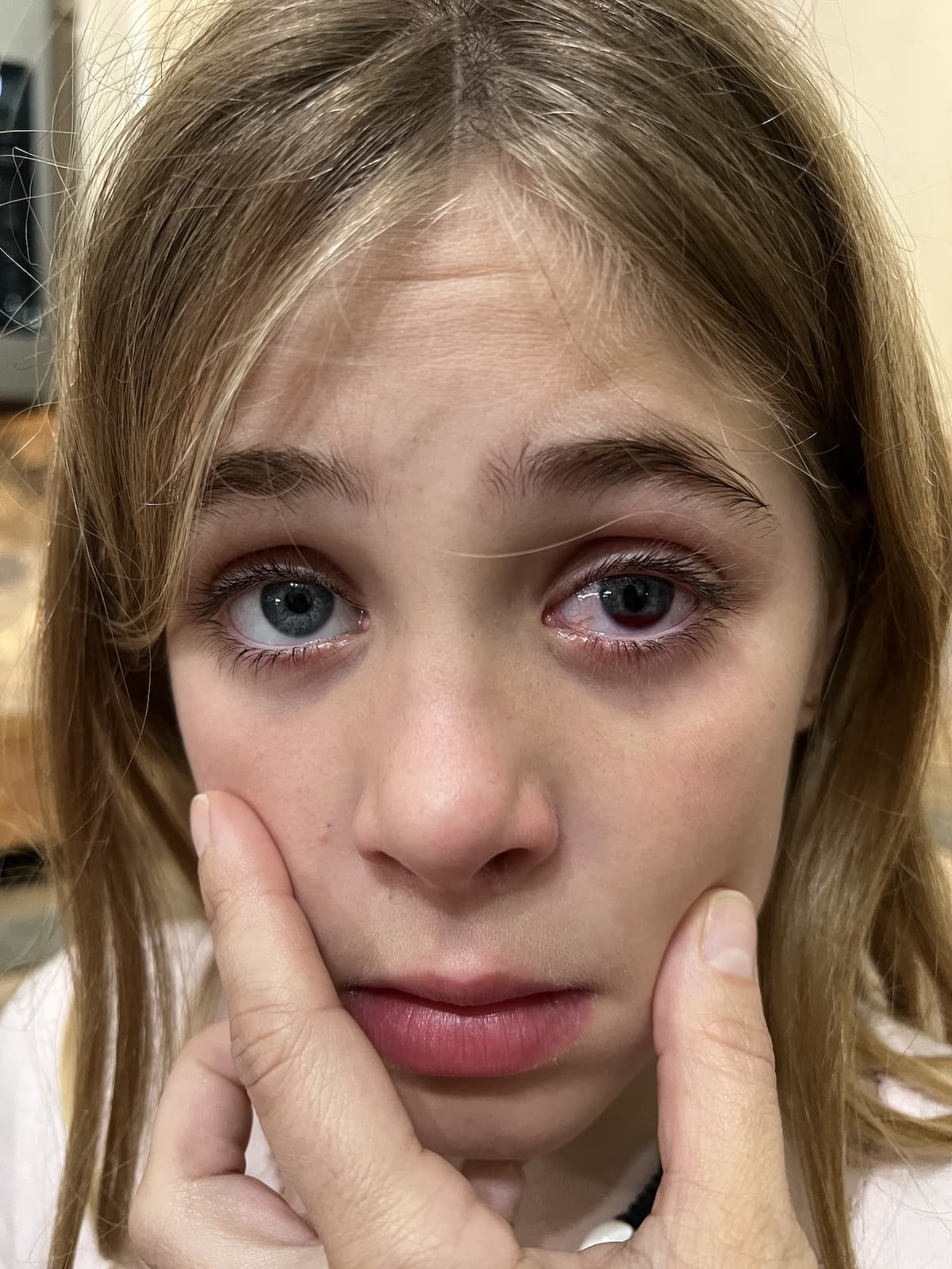 Nerf Gun Eye Injury: What to Do When Your Child Has Been Hit in the Eye with a Nerf Dart Bullet and How to Prevent Toy Gun Injuries